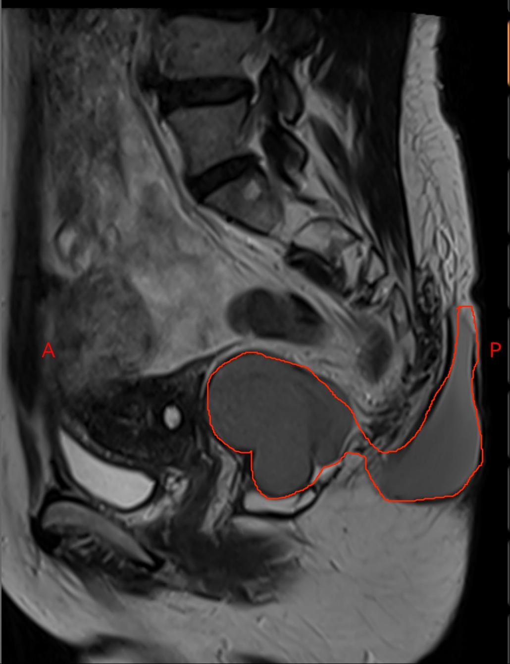 臀部长了一个瘤子是怎么回事,臀部上长个瘤子不疼不痒软软的