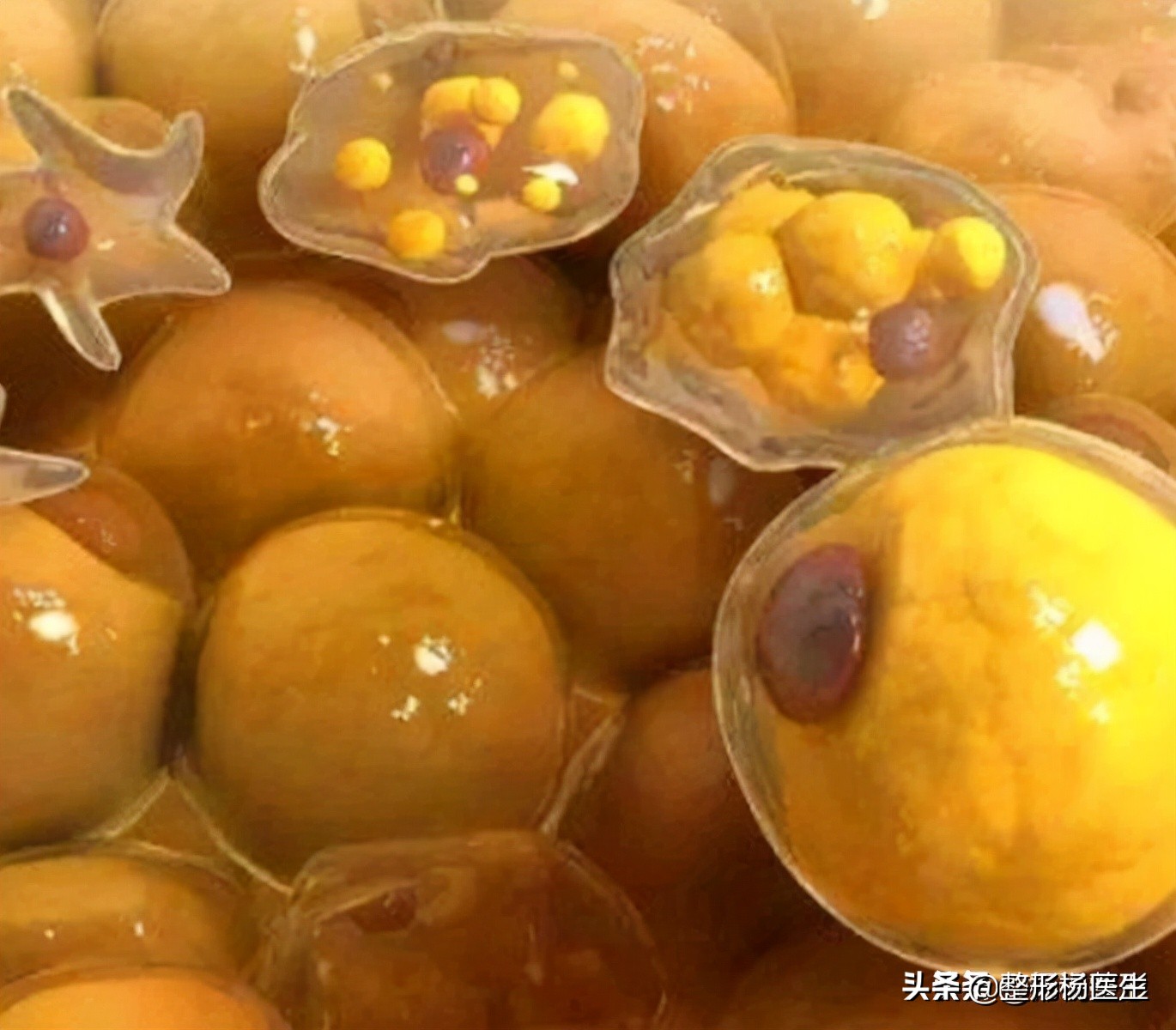 20岁面部凹陷如何改善,脂肪填充面部凹陷怎么导致的呢