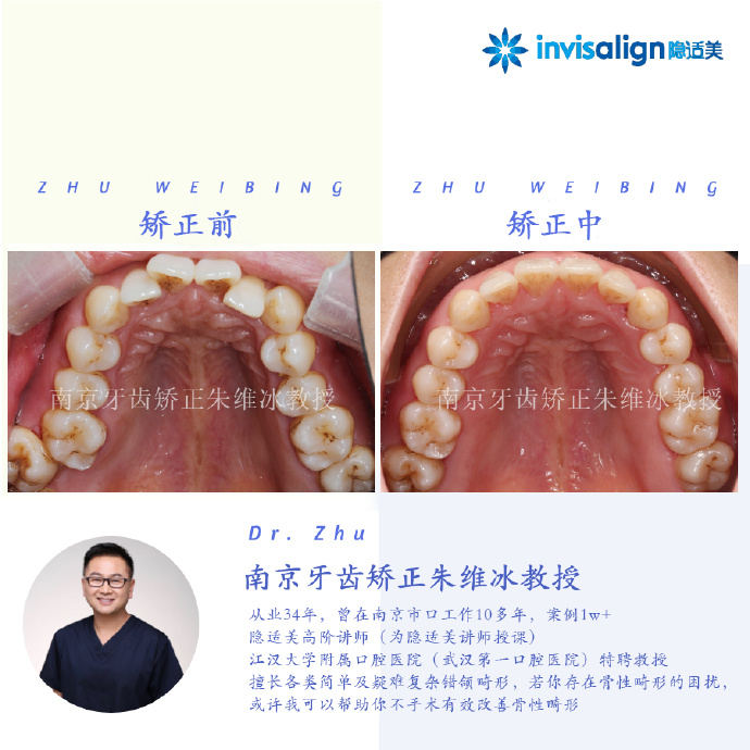 南京牙齿矫正:上颌骨性前突+下颌后缩+严重深覆合+牙齿拥挤