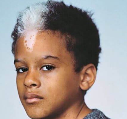 白斑是白癜风吗医生为你详解,得了白癜风感觉身上都是白斑