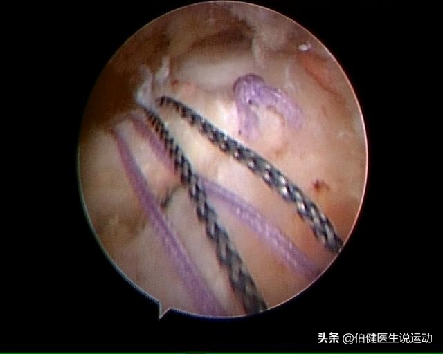 肩峰撞击综合征怎么办,游泳肩的治疗