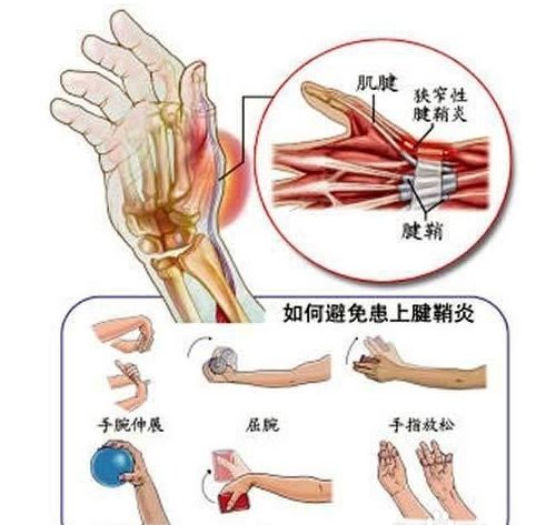 预防缓解腱鞘炎膏药,养生堂腱鞘炎预防与治疗视频
