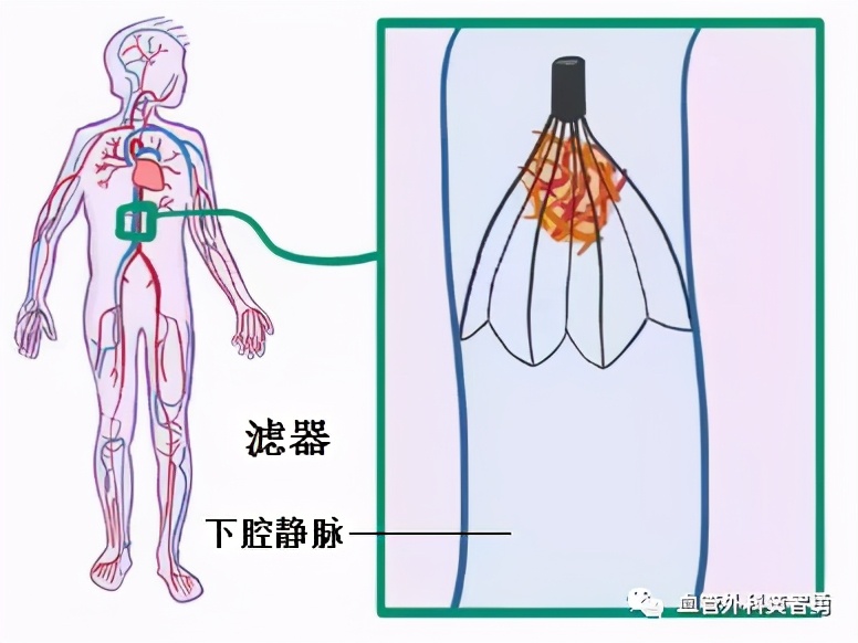 孕期下肢静脉血栓怎么治疗,卧床保胎预防血栓的腿部动作