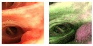 支气管镜高频电刀治疗中央型肺癌,支气管镜在早期肺癌诊断的意义