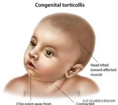 宝宝老是歪头后仰头,宝宝歪脖歪头怎么办