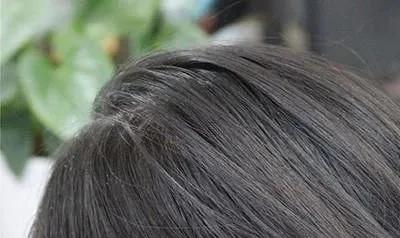 头皮屑特别多如何去掉头皮屑,头皮屑特别多怎么去除