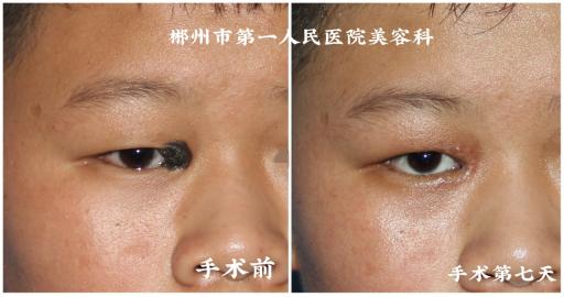 脸上有痣但不想点怎么弄掉,脸上很多痣遮不住