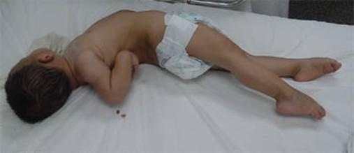 竹签刺破了手指要不要打破伤风针,竹签刺到会得破伤风吗