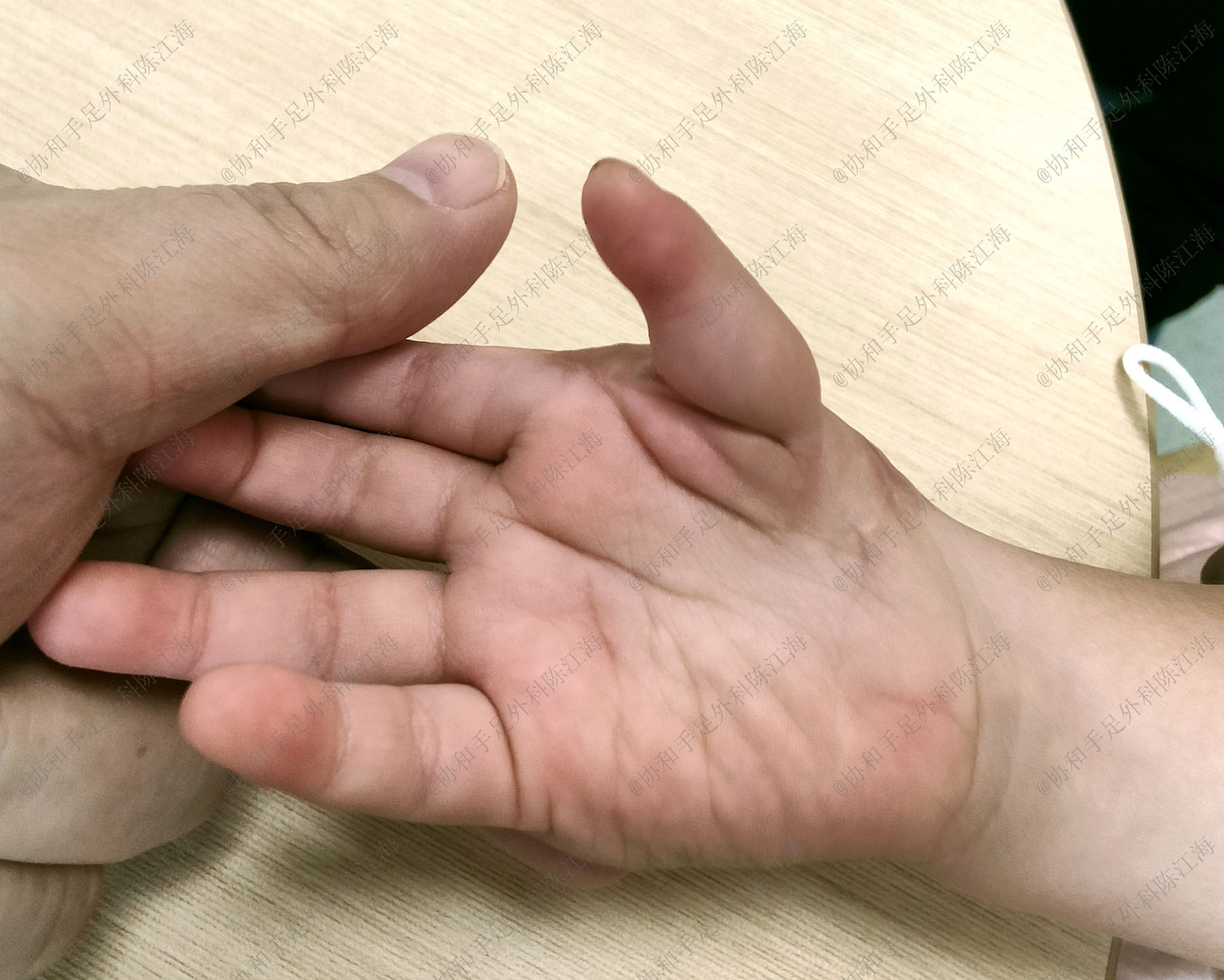 婴儿怎么看手指发育情况,宝宝手指多指是什么原因造成的