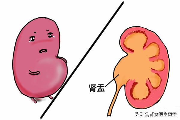 女性肾积水腰痛会影响小腿酸胀吗,肾积水腰疼怎么治疗需要住院吗