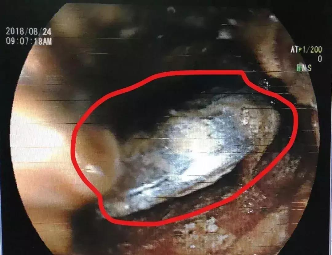 喉管长期被胃酸腐蚀会怎么样,小孩喉管被腐蚀