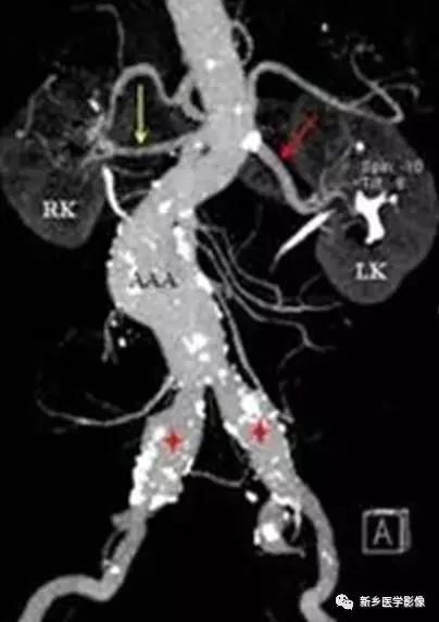 腹部平片能看到结石吗,腹部高密度结节影是什么