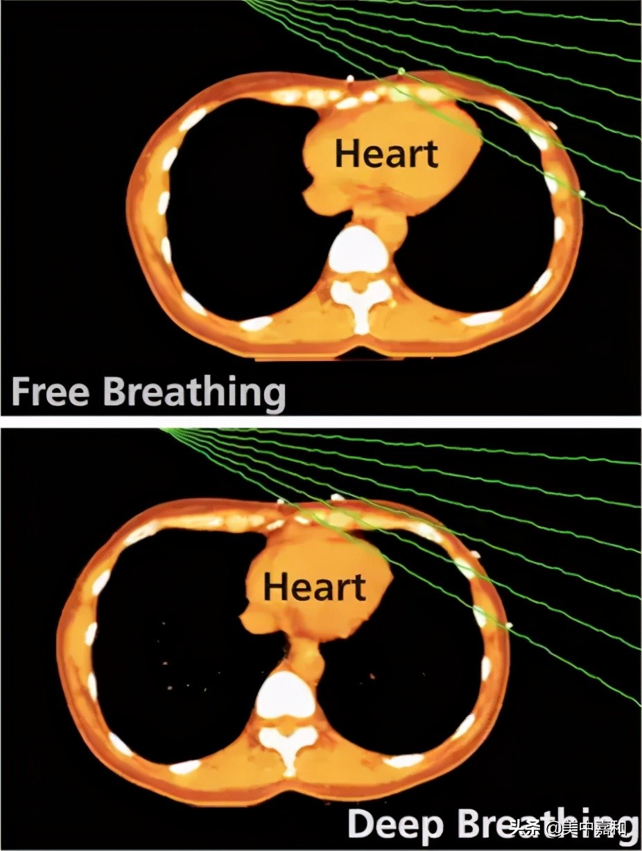 乳腺癌治疗和康复需注意什么？肿瘤医生划重点
