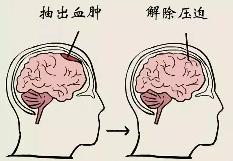 脑出血病人视频,脑出血一般寿命