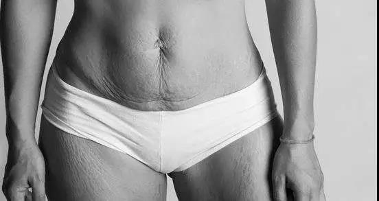 难看又难缠的肥胖纹，要如何预防和去除呢？