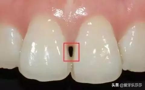 牙齿矫正后黑三角严重怎么办,儿童牙齿矫正会出现黑三角吗