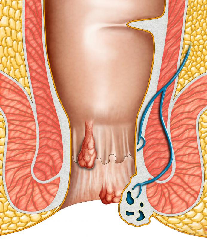 会玩的西方人,硬生生将它从治疗痔疮的工具,玩成性癖玩物