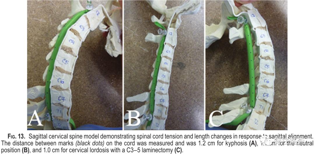 颈椎曲度变直诊断证明,3d演示颈椎生理曲度变直牵引过程