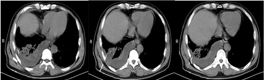 主任医师查房：这个“肺空洞”不简单