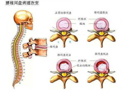 腰间盘突出膨出脱出是什么意思,腰椎间盘突出脱出膨出的区别
