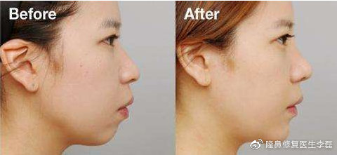 下巴骨雕整形是怎么回事,下巴整形一般要恢复多久