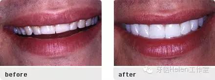 Helen齿科中心——全瓷贴面让你明眸皓齿不是梦