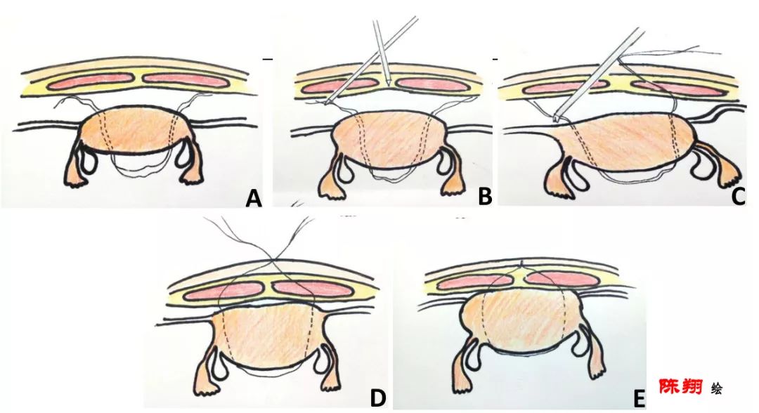 女子子宫脱垂如何保健恢复,省人民医院妇科治疗子宫脱垂