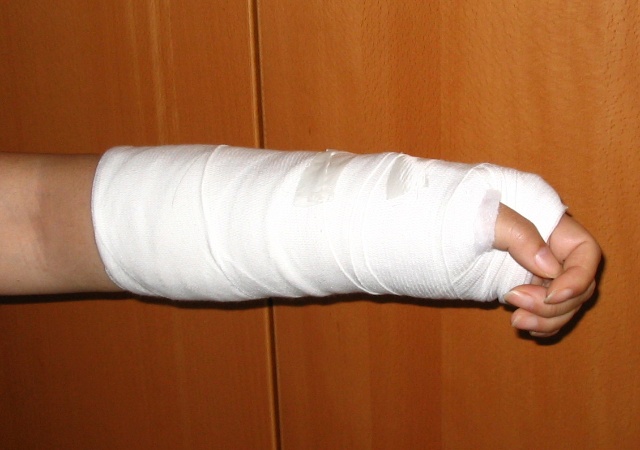 骨折筋伤哪个更容易恢复,骨折后伤筋动骨怎么恢复