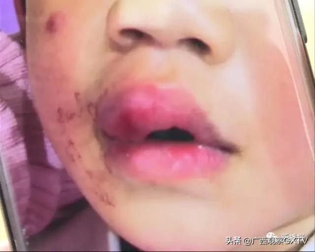 游乐场摔伤法律赔偿问题,小孩子在儿童乐园摔伤了怎么赔偿