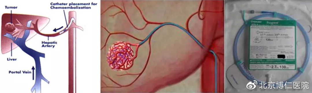 有关肝癌介入治疗的文章,肝癌早发现科普