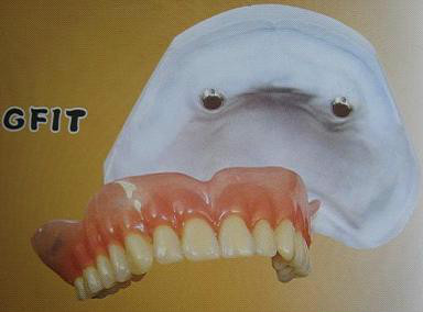 假牙最便宜一颗多少钱,假牙最贵