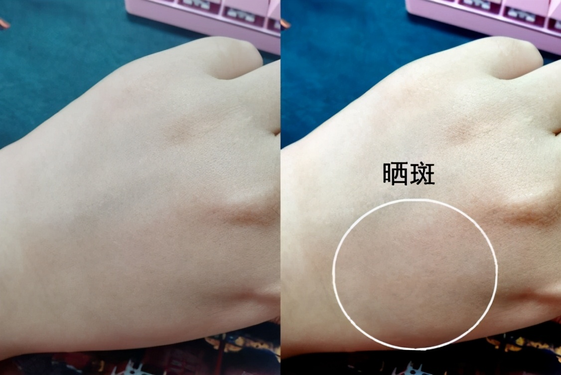 脸上长斑是激光还是用祛斑产品好,50岁年龄脸上长斑怎样能祛斑