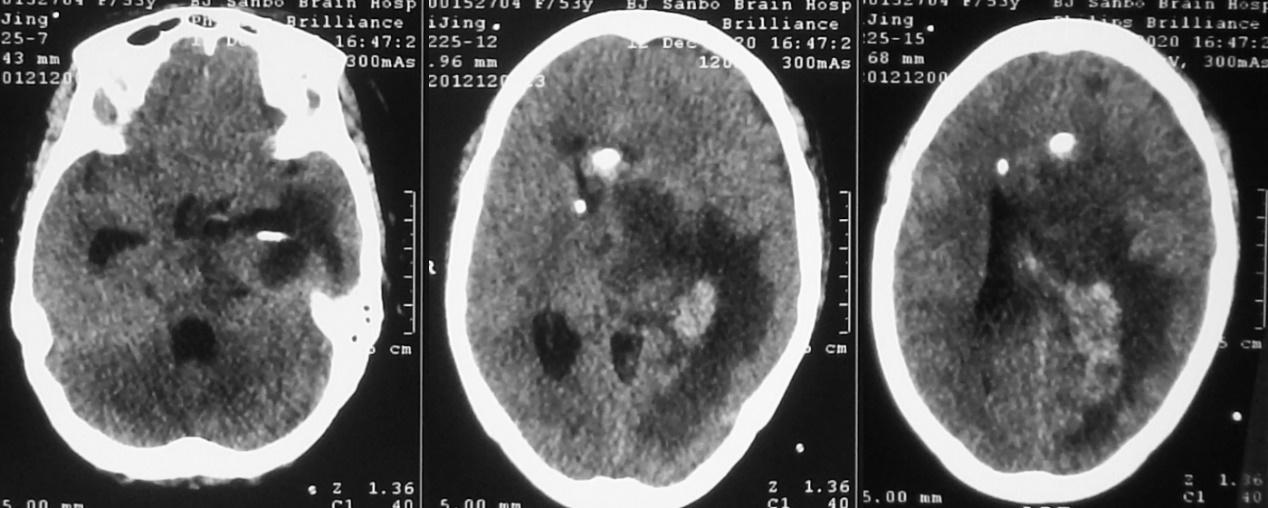 脑脓肿合并脑膜炎需要手术吗,脑脓肿进入左侧脑室严重吗