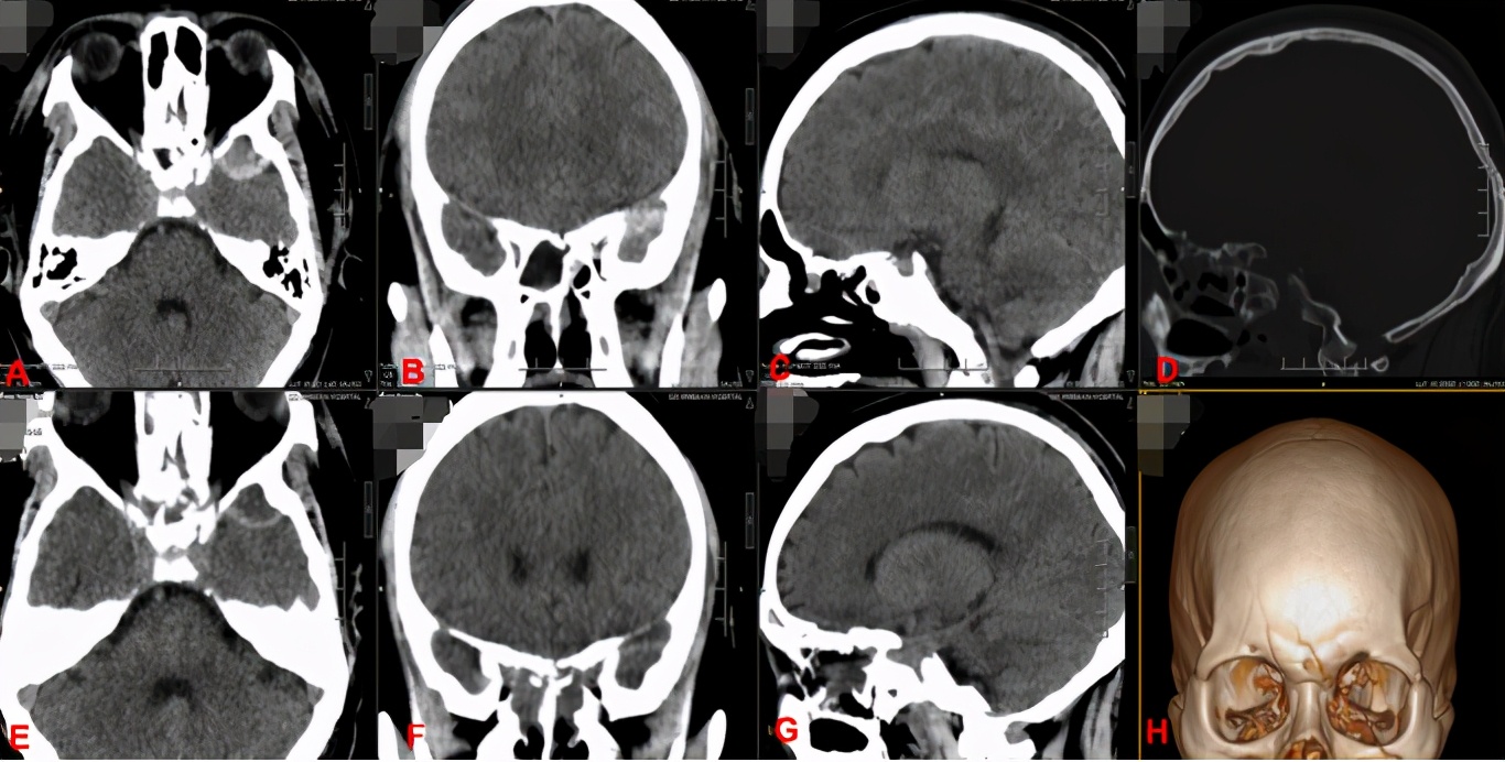 车祸导致眼睛失明奇迹恢复的案例,车祸导致左眼失明
