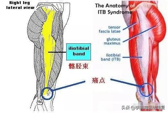 膝盖外侧疼痛活动不疼休息时疼,膝盖外侧髂胫束疼痛怎么办