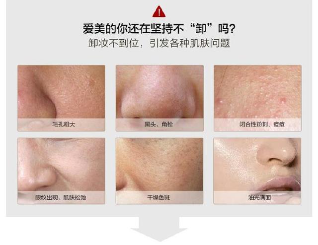 混油痘用什么卸妆品好,皮肤出油长痘严重如何改善