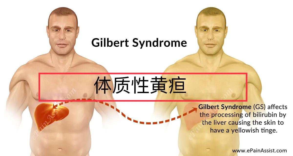 胆红素正常转氨酶高会是肝衰竭么,胆红素升高引发肝性脑病和黄疸