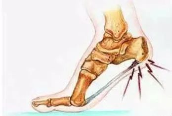 骨科康复医学科普骨刺,南阳医专一附院骨科就诊