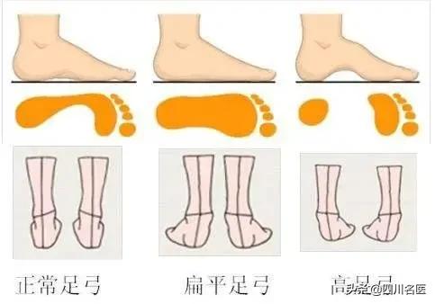 扁平足是不是走路容易脚疼,脚一走路就疼是扁平足吗