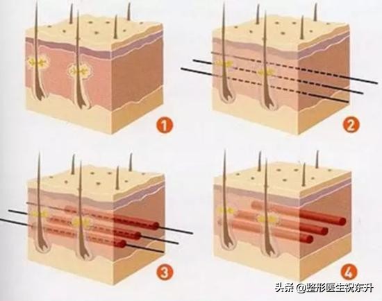 医生谈线雕面部提升危害,线雕提升能做吗
