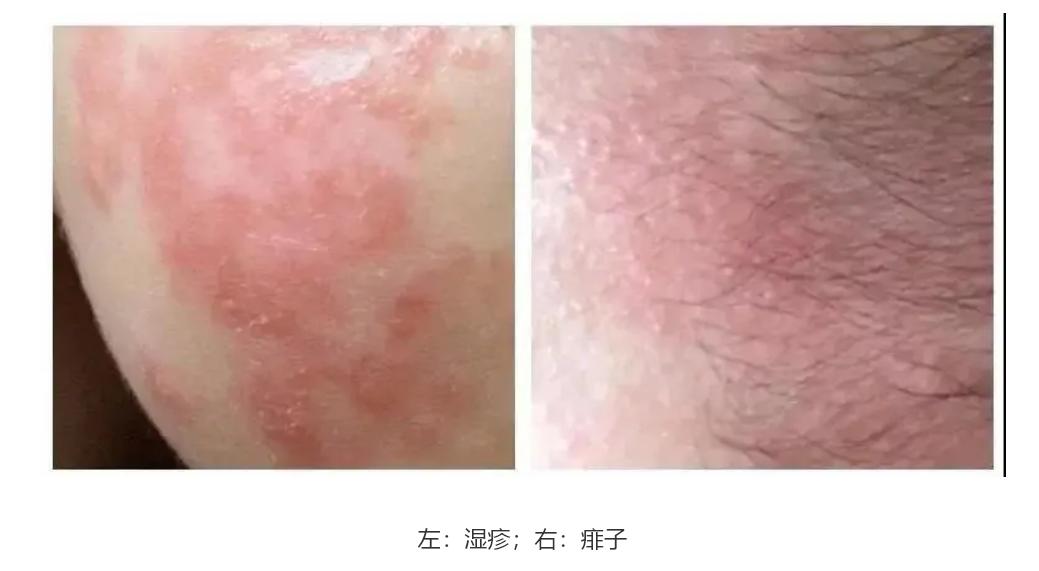 什么季节宝宝容易起湿疹,谁家宝宝长痱子了