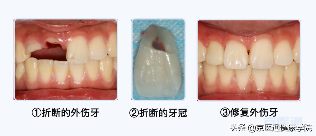 牙受伤后怎么保护,摔掉牙快速消肿方法