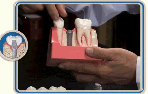 全瓷种植牙的牙基也是全瓷粉吗,种植牙全瓷和烤瓷有什么区别