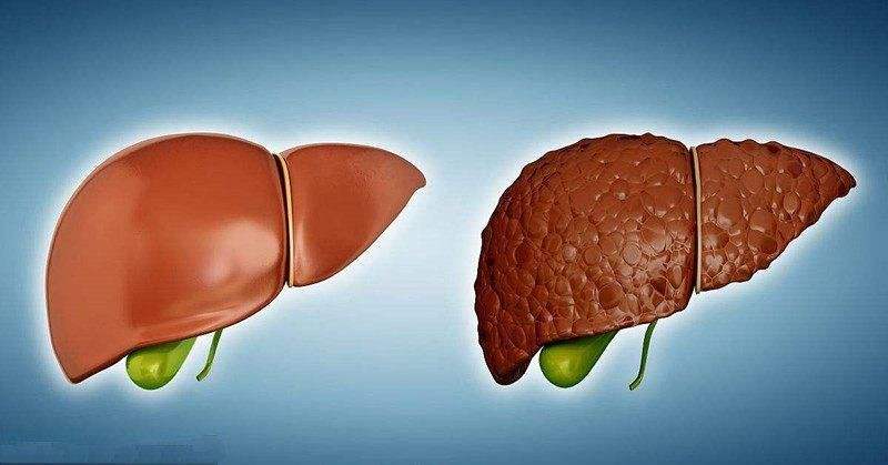 肝硬化脾脏大了还会小下去吗,肝硬化脾大一定要做脾脏栓塞吗