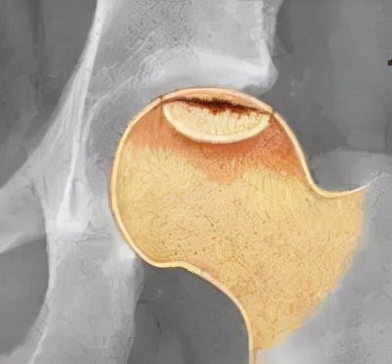 股骨头坏死和腰间盘突出症状区别,椎间盘突出和股骨头坏死症状区别