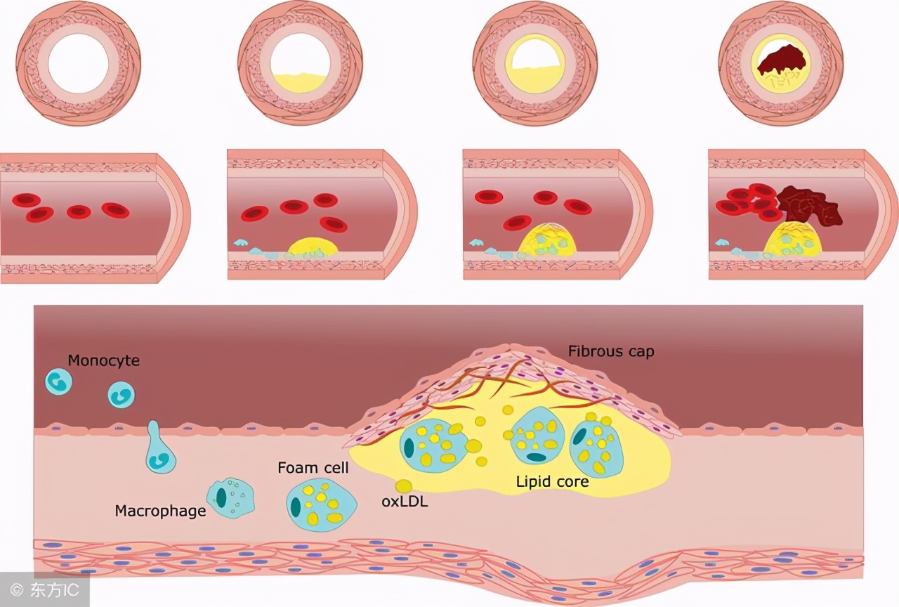 低密度脂蛋白高是什么意思,低密度脂蛋白4.5严重吗