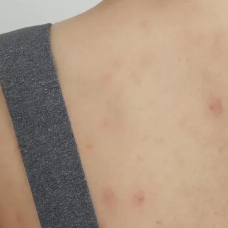 又到了穿小裙的季节，鸡皮女孩该怎么办……