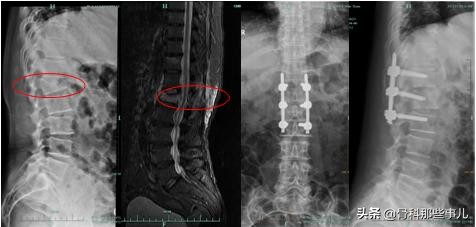 专家建议：老年人出现腰椎骨折，不一定需要做手术！