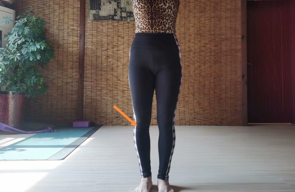 小腿外翻膝超伸如何改善,单侧膝超伸导致腿短一点