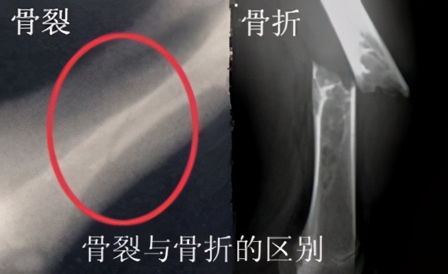 骨折和骨裂有什么区别哪个更严重,骨折和骨裂有什么区别视频